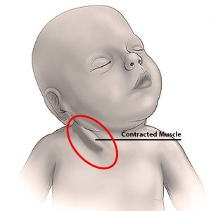 contrattura dello Scom destro di un neonato