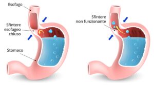 rappresentazione grafica del reflusso gastroesofageo