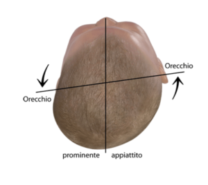 rappresentazione schematica di una plagiocefalia